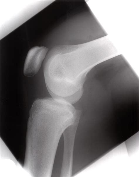 healthy knee photograph  daniel sambrausscience photo library fine