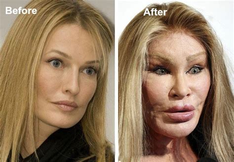 Plastic Surgery Gone Wrong For These 15 Actresses