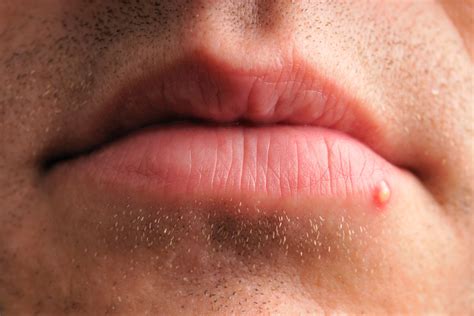 white spots  lips herpes lipstutorialorg