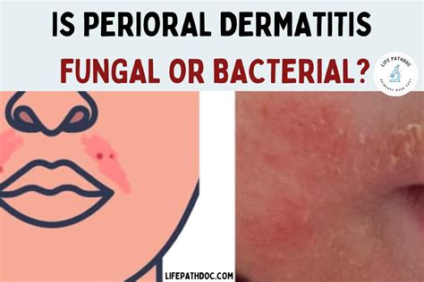 Is Perioral Dermatitis a Fungal or Bacterial Condition?