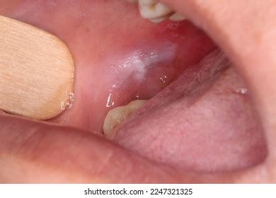 White Spot Located On Right Cheek Stock Photo 2247321325 | Shutterstock