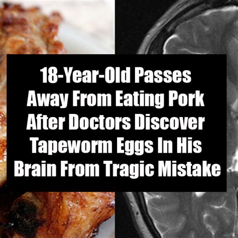 18-Year-Old Passes Away From Eating Pork After Doctors Discover ...