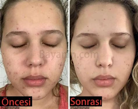 Clindoxyl Jel Yüzde Kaç Saat Kalmalı? Ne İşe Yarar?