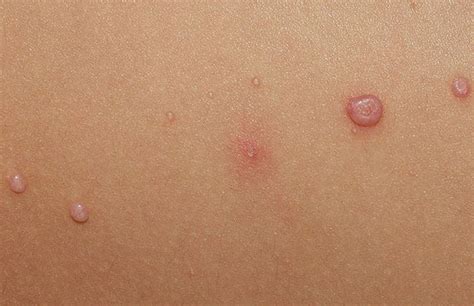 Прыщи - причины, лечение | Kosmetologiya-dermatologiya.az