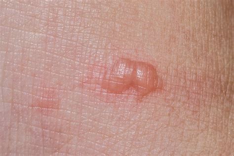 Cat scratch fever: Causes, symptoms, and complications