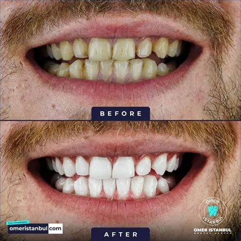 Teeth Whitening in Turkey: Get a Brighter, Whiter Smile Instantly