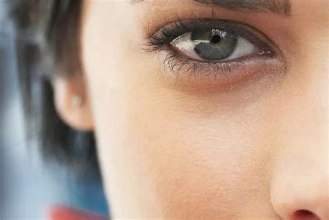 Темные круги под глазами | Periorbital dark circles, Dark eye circles ...