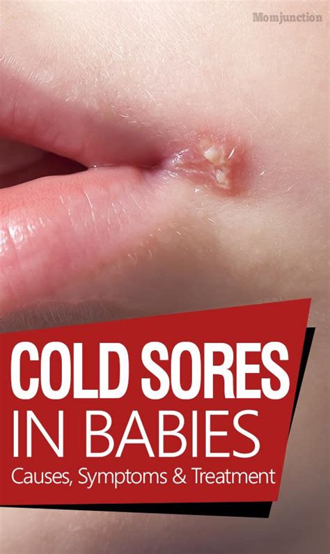 Cold Sores In Babies: Causes, Symptoms And Treatment