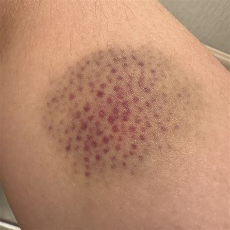 Weird Looking Bruise : r/medical