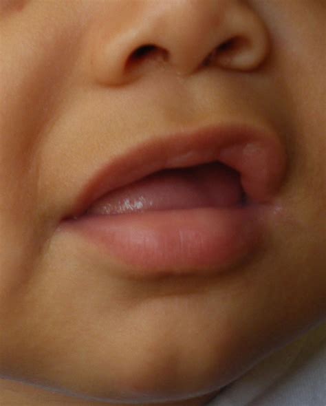 Congenital Causes Of Macroglossia - Klarity Health Library