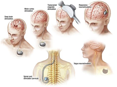 Neurostimulation Devices for the Treatment of Neurologic Disorders