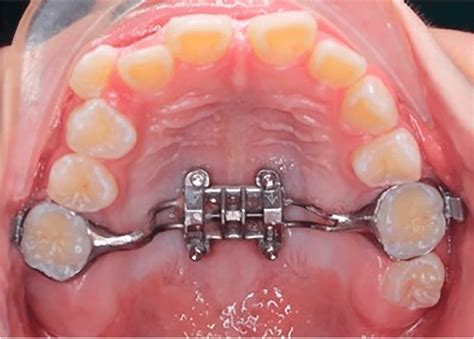 MSE in place of one of the patients. | Download Scientific Diagram