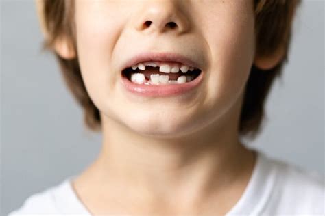 Krivi Zubi kod Dece i Odraslih - 7 Uzroka | MND Dental