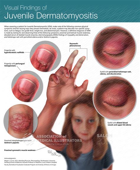 Visual Findings in Juvenile Dermatomyositis | AMI Cleveland 2015