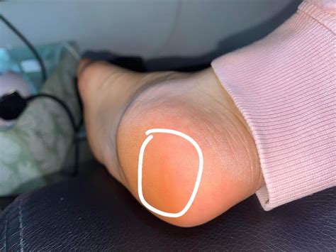 what is this bump and pain on back bottom of heel? soreto put pressure