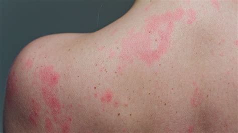 Rash Symptoms and Diagnosis - Southeast Medical Group