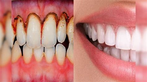 how to get rid of black spots on teeth