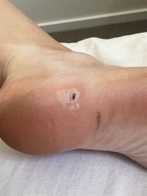 Plantar wart acv : r/plantarwarts