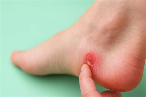blister treatment podiatry international