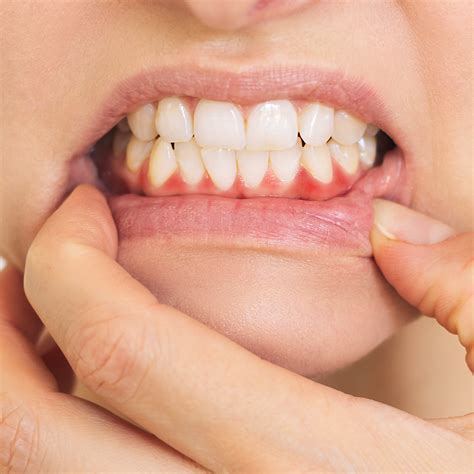 Gum Disease in Kyle, TX | Kyle Parkway Dentistry