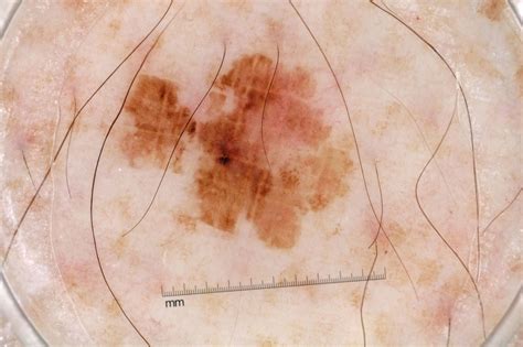 Moth-eaten Border | Dermatoscopes.com