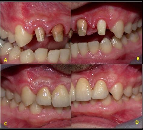 Preparation and crowing of the anterior teeth. (A,B) Preparation of ...