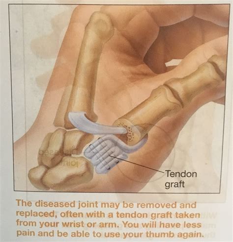 Basal Joint Arthroplasty Recovery at Robert Guajardo blog