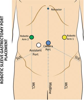Robotic Sleeve Gastrectomy | Basicmedical Key