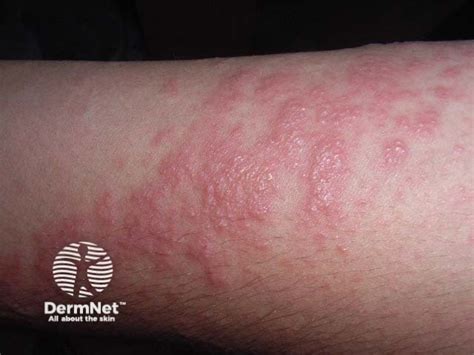Dermatitis. Photosensitivity dermatitis