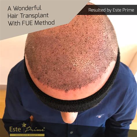 FUE Hair Transplant. A Wonderful Hair Transplant With FUE… | by Hair ...