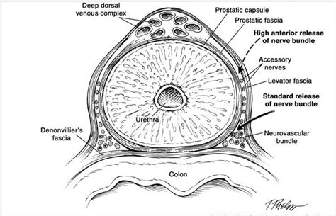 robotic nerve sparing radical prostatectomy department  urology