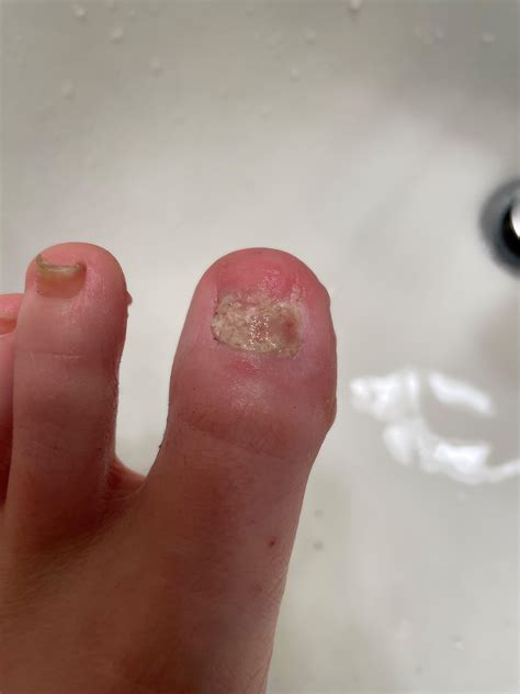 Had a toenail removed 2 weeks ago. I keep it wrapped with antibiotic