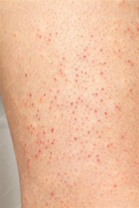 Premium Photo | Macro of skin with folliculitis Closeup of woman hair ...