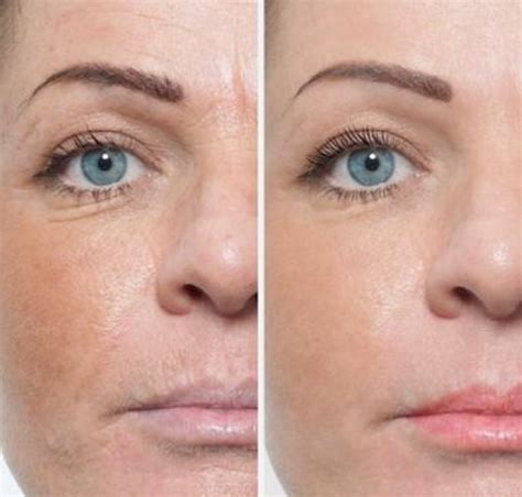 Laser Fotona Antes E Depois - Laser Fotona 4D - tudo que você precisa saber antes de realizar - Blog ...