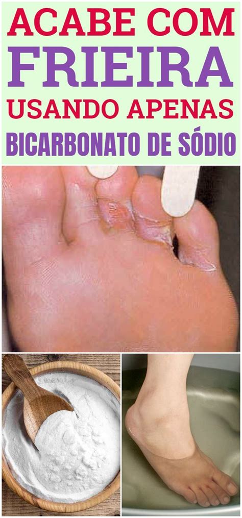 O Que É Bom Pra Frieira - ACABE com a FRIEIRA com Apenas 1 Ingrediente Caseiro! | Como quitar ...