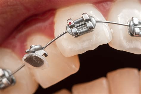 How the Myobrace Works | Ahava Orthodontics