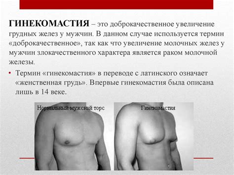 Гинекомастия. Виды истинной гинекомастии - презентация онлайн
