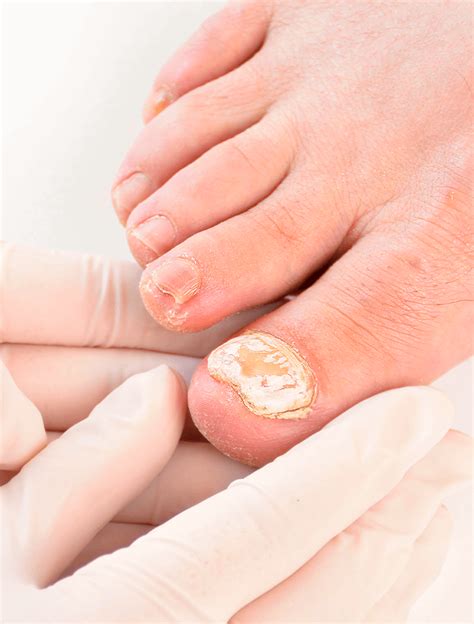 Tratamiento para onicomicosis_clínica dermatológica isela méndez ...