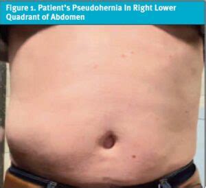 Abdominal Pseudohernia and Urinary Retention Due to Spinal Nerve Root ...