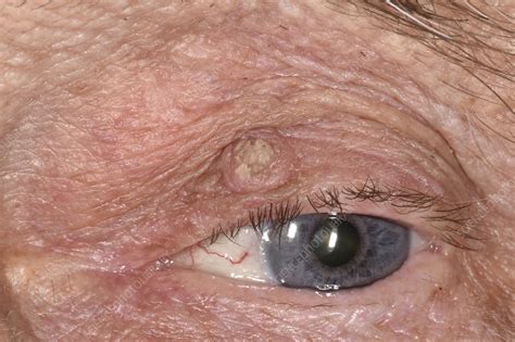 Keratoacanthoma - Stock Image - C047/2856 - Science Photo Library