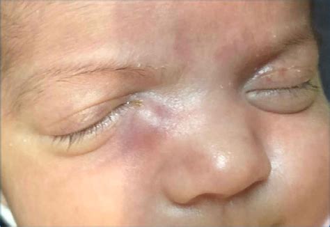 bilateral congenital dacryocystocele complicated  acute