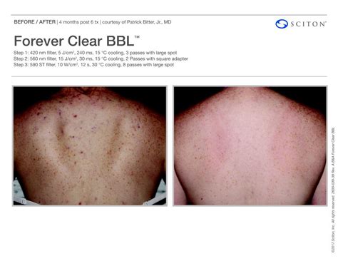 SCITON BBL Gallery - Covet Med Spa in Southfield, Michigan