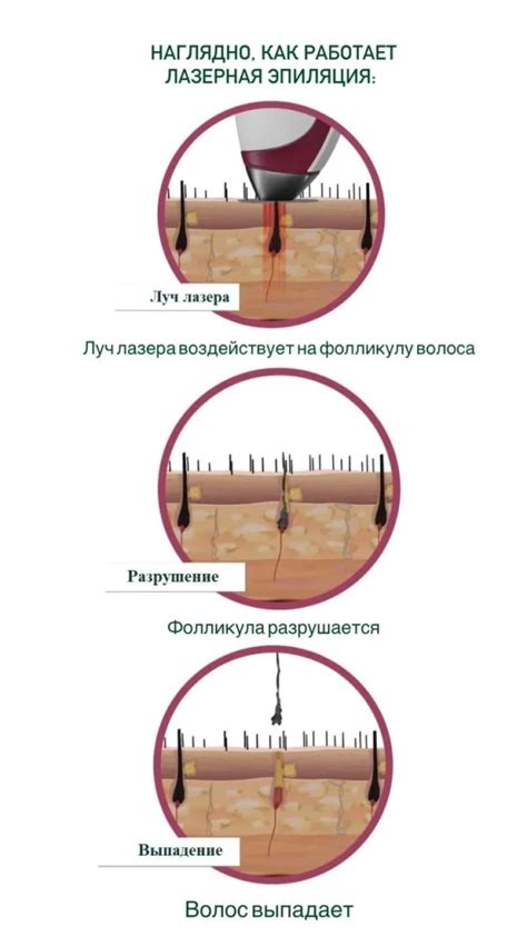 Лазерная эпиляция в СПб: лазерное удаление волос навсегда