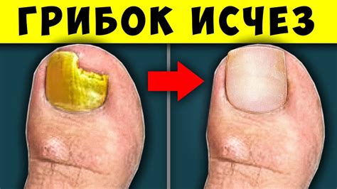 Вот, как убрать Грибок РАЗ и НАВСЕГДА. Избавься от ГРИБКА Ногтей на ...
