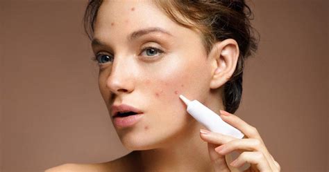 The Correct Way to Apply and Use Acne Spot Treatment