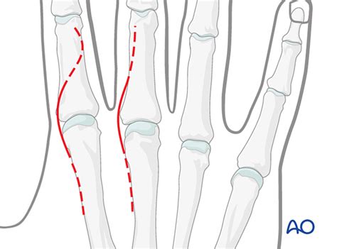 Dorsal approach to the metacarpophalangeal joints
