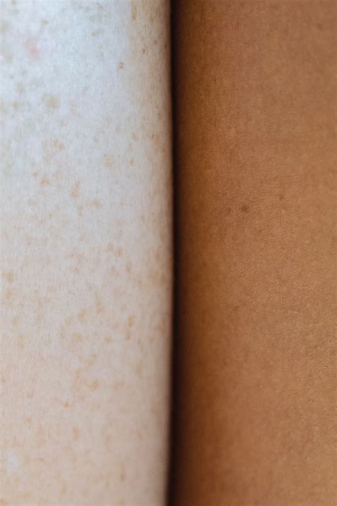 Laser Therapies | Discover Effective Laser Treatments — The Skin RN