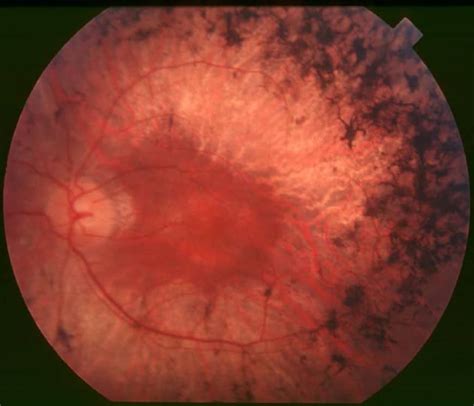 Retinitis Pigmentosa - almostadoctor