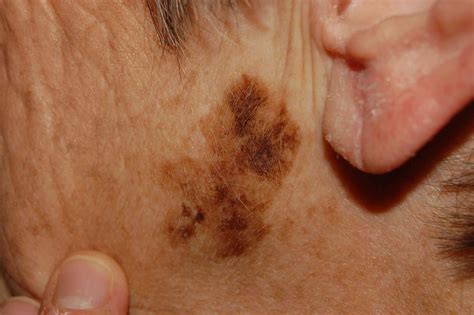 The ABCDE Rule of Skin Cancer