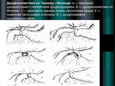 Современные методы лечения язвенной болезни - презентация онлайн
